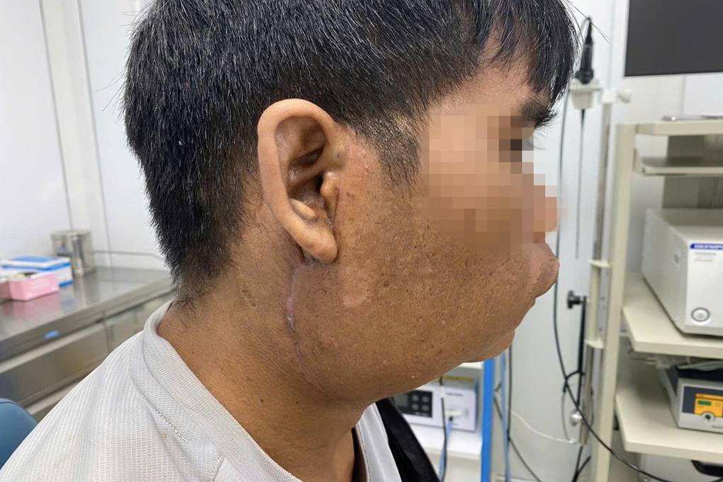 Chàng trai 10 năm mang 2 khối u lạ, mổ xong lại mọc lên và phình to - 3 Chàng trai 10 năm mang 2 khối u lạ, mổ xong lại mọc lên và phình to - 3