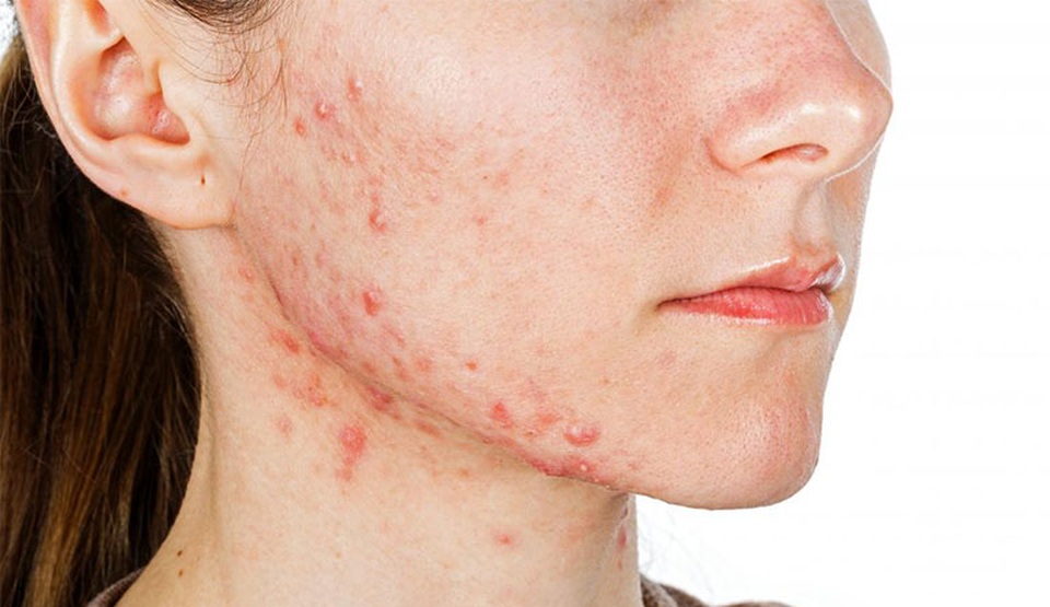 Da nổi mụn: Có phải gan đang gặp vấn đề? - 1 Da nổi mụn: Có phải gan đang gặp vấn đề? - 1