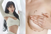 Rộ tin diễn viên nổi tiếng "vỡ ngực" khi tập gym: Bác sĩ thẩm mỹ lên tiếng