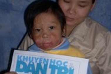 Quỹ Nhân ái đến với em bé có làn da bỏng lửa 