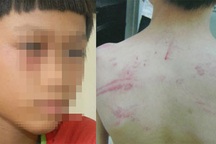 Bé trai 9 tuổi bị cha ruột hành hạ dã man