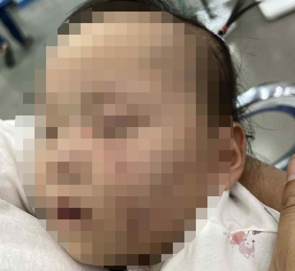 Xác minh vụ bé gái với nhiều vết bầm trên mặt sau khi đi lớp - 1 Xác minh vụ bé gái với nhiều vết bầm trên mặt sau khi đi lớp - 1