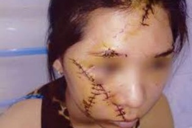 Một trẻ 13 tuổi bị bạn rạch mặt vì… ghen