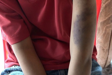 Bé trai 14 tuổi nghi bị bố và mẹ kế đánh bầm tím khắp người