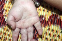 Bé một tháng tuổi ở Hà Nội mắc ghẻ, căn bệnh bị nhiều người lãng quên