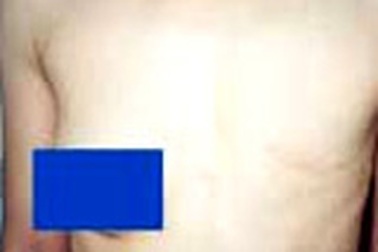 Nhũ hoa bất thường