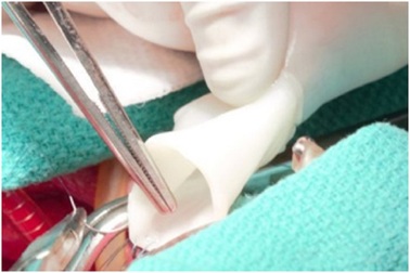 Nghiên cứu đột phá: Mạch máu nhân tạo có thể tiếp tục phát triển sau khi cấy ghép