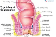 Thoát khỏi nỗi sợ ung thư hậu môn nhờ kết hợp các phương pháp điều trị chuẩn Mỹ