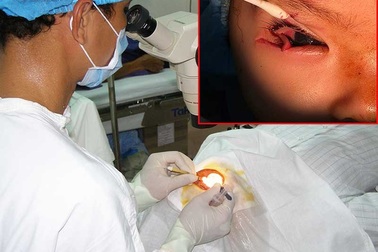 Múc bỏ mắt do tai nạn bất ngờ