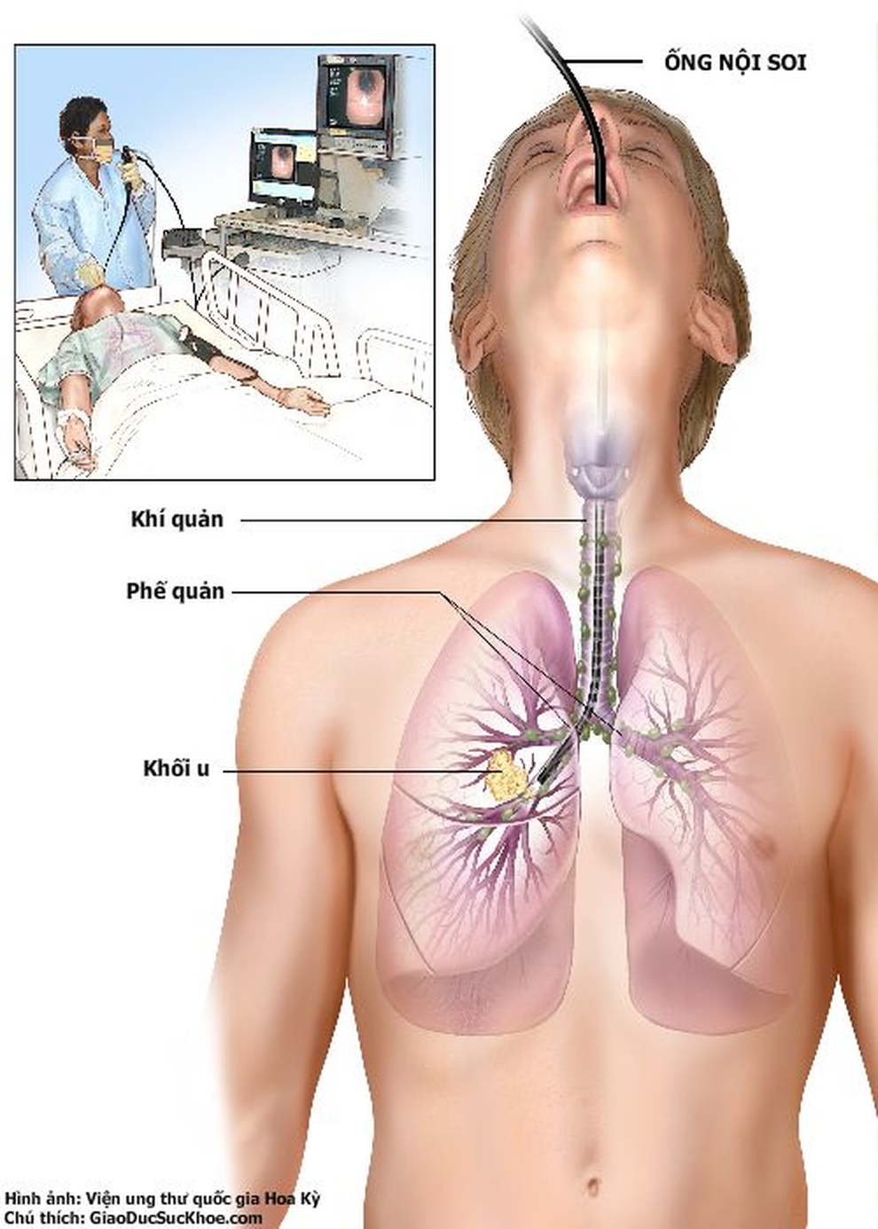 Có dấu hiệu nuốt nghẹn, làm sao để chẩn đoán ung thư thực quản - 1 Có dấu hiệu nuốt nghẹn, làm sao để chẩn đoán ung thư thực quản - 1