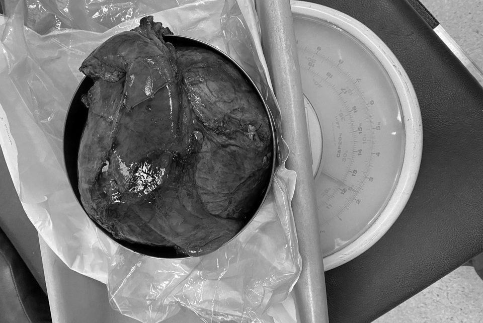 Tăng hơn 10kg, nữ bệnh nhân tá hỏa phát hiện khối u tụy khổng lồ - 2 Tăng hơn 10kg, nữ bệnh nhân tá hỏa phát hiện khối u tụy khổng lồ - 2
