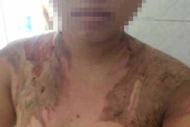 Bắt giam người đàn ông dội nước sôi lên cơ thể vợ