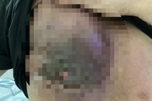 Ngực tím đen, lở loét vì dùng thuốc nam chữa ung thư