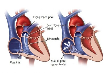 Hở van tim 3 lá 1/4 không quá nguy hiểm nhưng chớ chủ quan
