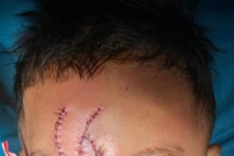 Chơi trước nhà, bé trai 5 tuổi bị chó béc-giê cắn biến dạng mặt nặng nề