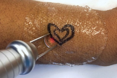 Tình yêu tan vỡ, cô gái cầu cứu bác sĩ xóa hình xăm nhạy cảm