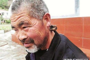 Người đàn ông mọc sừng trên cổ