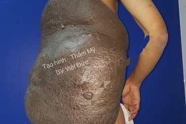 Chiếc “mai rùa” khổng lồ trên lưng khiến chàng trai 26 năm phải ngủ ngồi