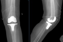 Thay khớp gối nhân tạo tuổi thọ trên 20 năm giúp người phụ nữ thoát viêm khớp nặng