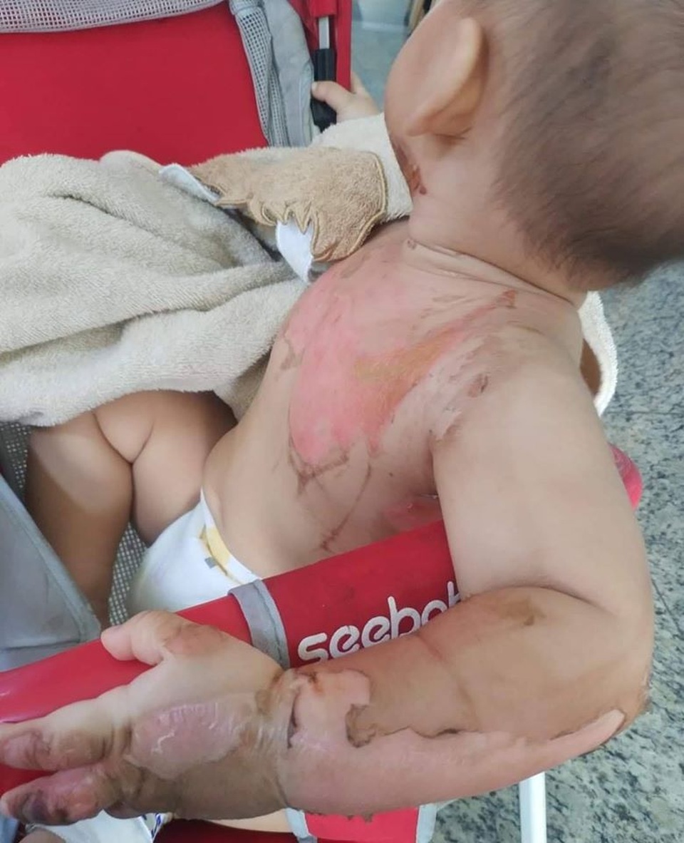 Bị nước sôi đổ lên người, bé 2 tuổi bỏng nặng - 1