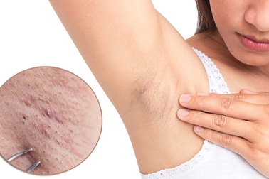 Có nên nhổ lông nách?