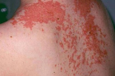 Cách phân biệt vết zona thần kinh, "giời leo" và kiến ba khoang cắn