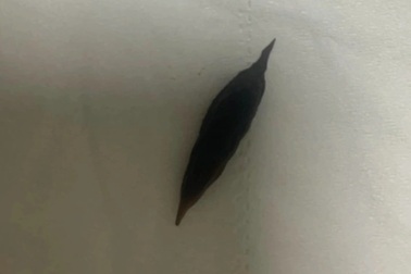 Ăn yến chưng nuốt luôn hạt táo đỏ, người phụ nữ thủng ruột