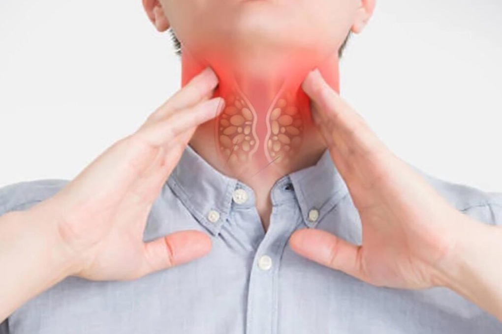 Ung thư thực quản giai đoạn 4: Dấu hiệu và phương pháp điều trị - 1 Ung thư thực quản giai đoạn 4: Dấu hiệu và phương pháp điều trị - 1