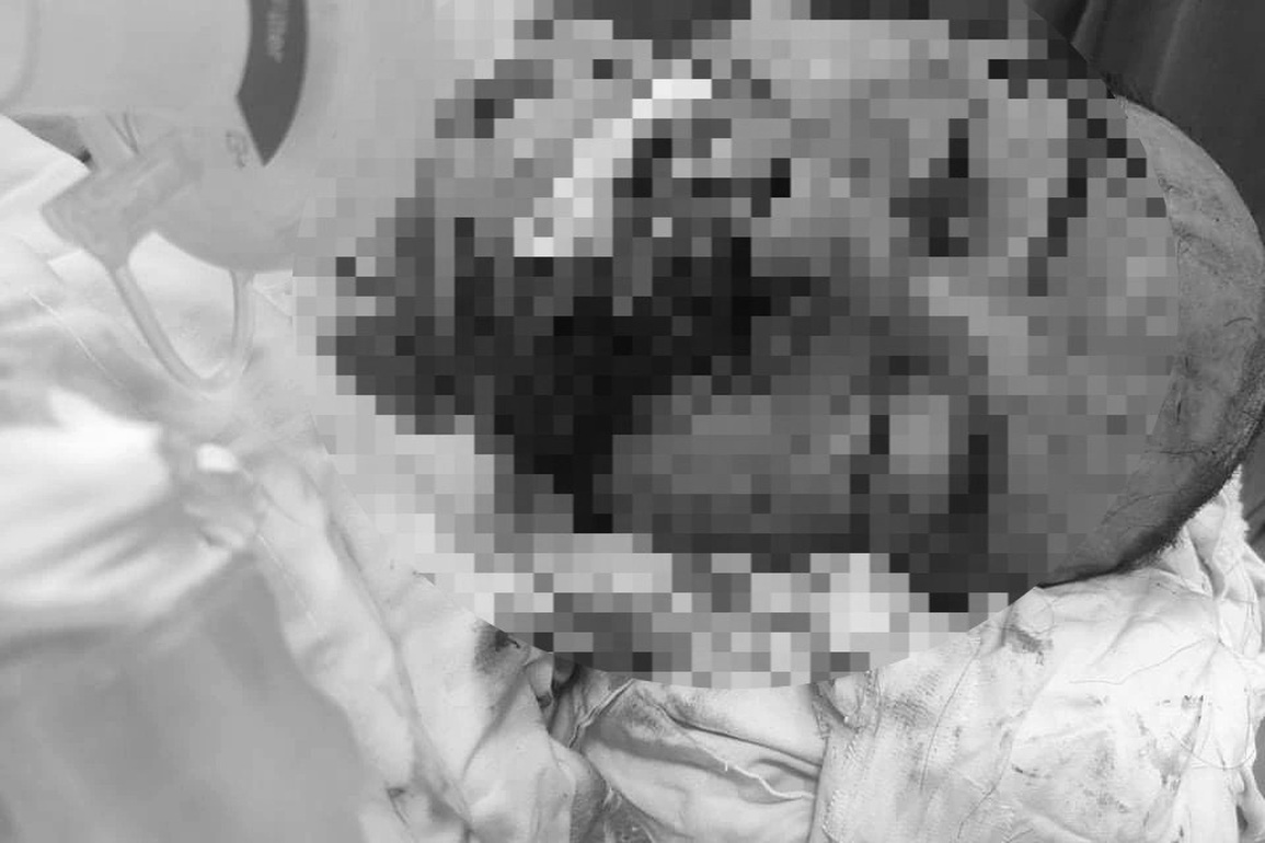 Cứu sống một bệnh nhân rất nguy kịch do bị máy cày chém - 1 Cứu sống một bệnh nhân rất nguy kịch do bị máy cày chém - 1