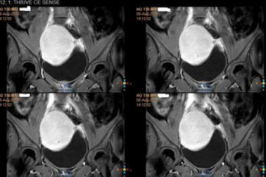 Gần 80% phụ nữ trên 50 tuổi bị u xơ tử cung