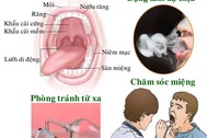 Ung thư miệng: Phòng bệnh được từ xa quý chừng nào!