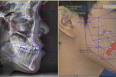 Cơ hội niềng răng miễn phí 100%