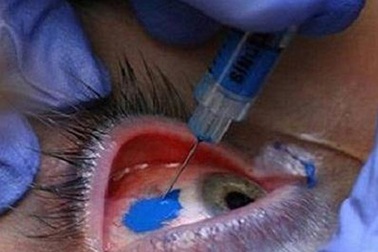 “Xăm tròng mắt” - Kiểu làm đẹp kỳ quái?