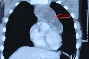 Mọc thêm khối u to như quả cam trong lồng ngực, nam thanh niên suýt tử vong