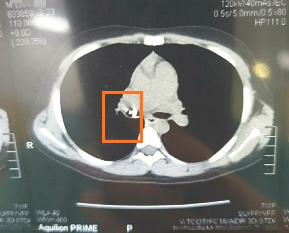 Bé gái đau ngực suốt 2 tháng sau khi được mẹ nhổ răng hàm - 1 Bé gái đau ngực suốt 2 tháng sau khi được mẹ nhổ răng hàm - 1
