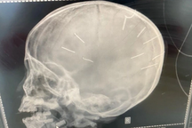 Vụ bé gái bị đóng 10 đinh vào đầu: 5 lần bị người tình của mẹ tra tấn