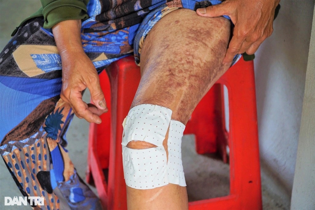 Mẹ nghèo lóc da cứu con trai bỏng nặng - 3 Mẹ nghèo lóc da cứu con trai bỏng nặng - 3
