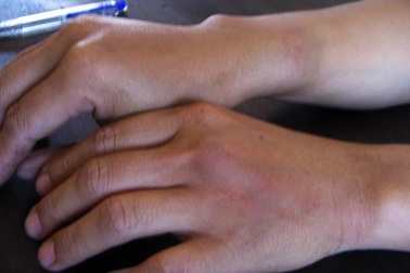 Một phụ nữ bị cán bộ quy tắc đô thị đánh bầm tay 