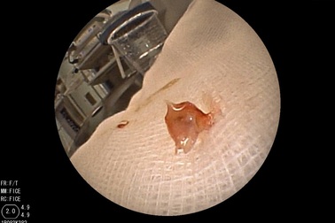 Xương lươn lọt vào đường thở khi tập ăn dặm, bé gái tắc một nhánh phổi