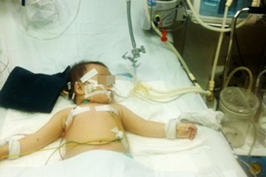 Bé 1 tuổi cấp cứu vì uống nhầm dầu luyn đựng trong chai nước ngọt