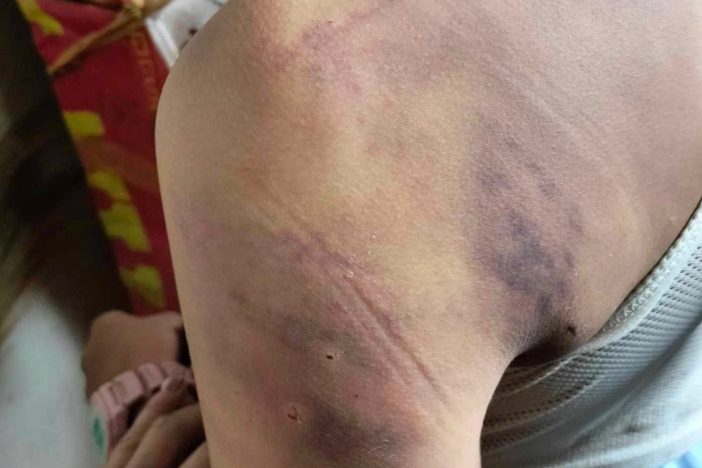 Chủ tịch huyện chỉ đạo xử lý nghiêm vụ nữ sinh lớp 4 bị 10 bạn đánh dã man - 1 Chủ tịch huyện chỉ đạo xử lý nghiêm vụ nữ sinh lớp 4 bị 10 bạn đánh dã man - 1