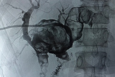 Đau bụng đi khám, người phụ nữ phát hiện sỏi đúc khuôn đầy trong gan