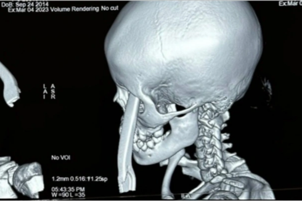 Bé gái 9 tuổi ở TPHCM bị tay thắng xe đạp đâm xuyên mắt khi chơi gần nhà - 1 Bé gái 9 tuổi ở TPHCM bị tay thắng xe đạp đâm xuyên mắt khi chơi gần nhà - 1
