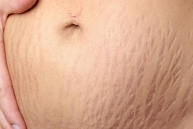 Cải thiện rạn da khi mang thai bằng cách nào cho an toàn?