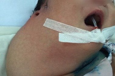 Bướu bạch huyết khổng lồ chặn đường thở trẻ sơ sinh
