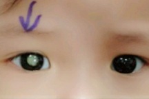 Bé 2 tuổi phải múc bỏ mắt vì phát hiện ung thư muộn